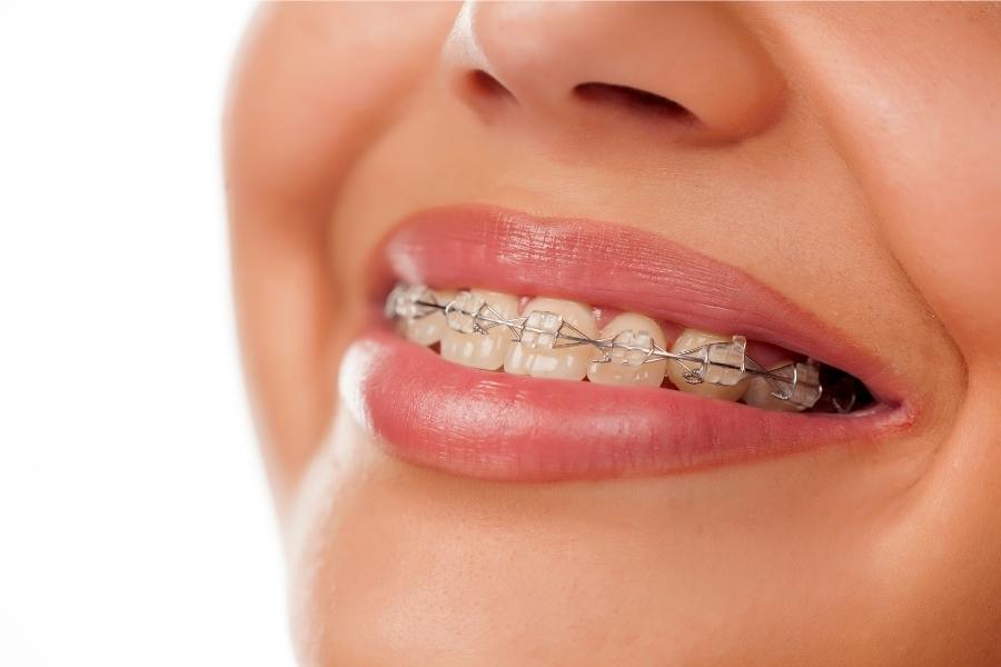 Do Fashion Braces Work?