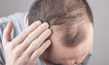 Hair Loss – 5 Causes and What You Can Do About Them