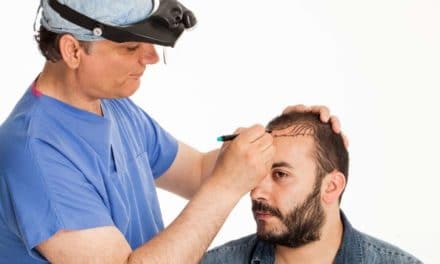 All You Need To Know About A Hair Transplants