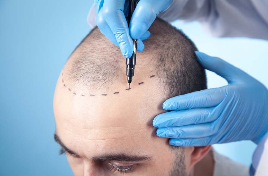 hair transplantation