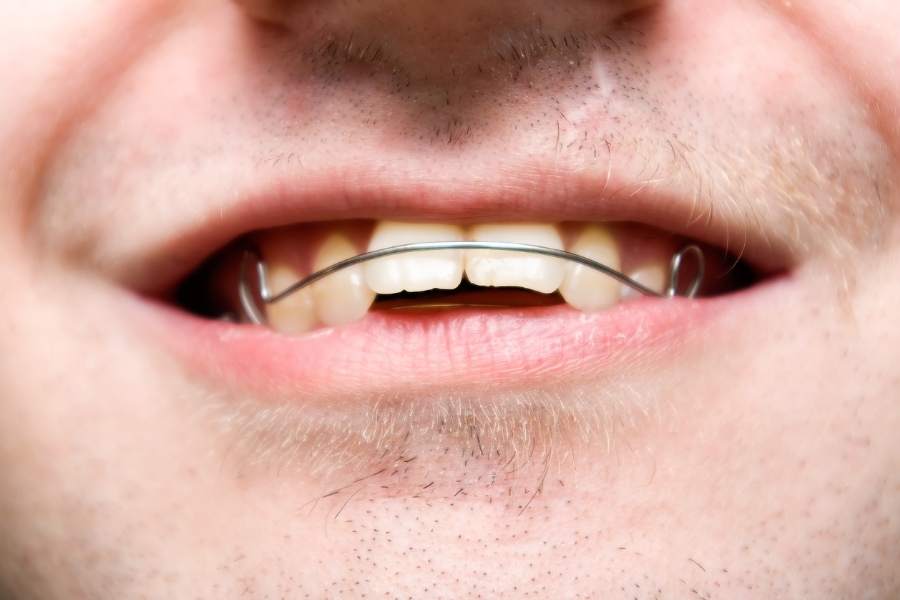 Overbite VS Underbite: What’s The Difference?