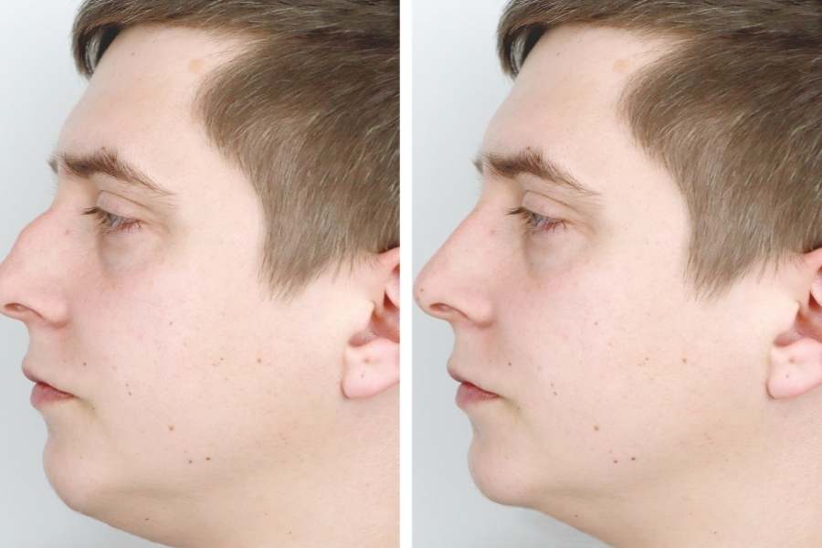 Rhinoplasty