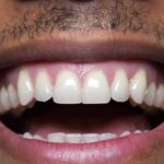Is Teeth Whitening Safe? Expert Insights and Analysis