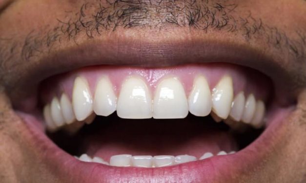 Is Teeth Whitening Safe? Expert Insights and Analysis